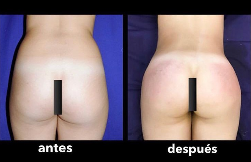 Butt augmentation with fat transfer