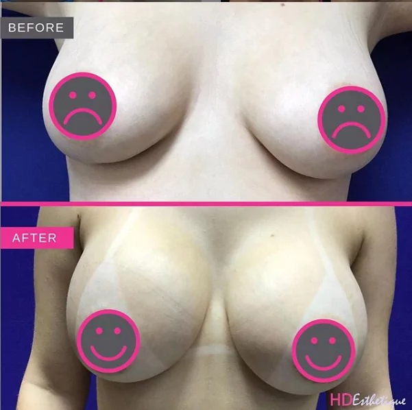 breast aumentation before after miami