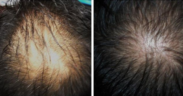 hair growth with prp treatment
