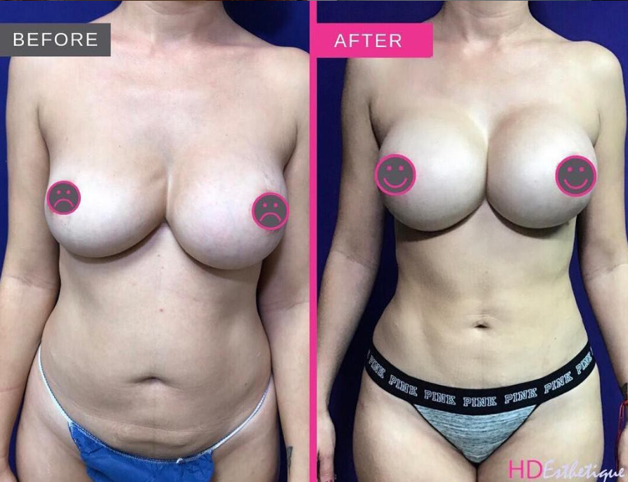 liposuction before & after