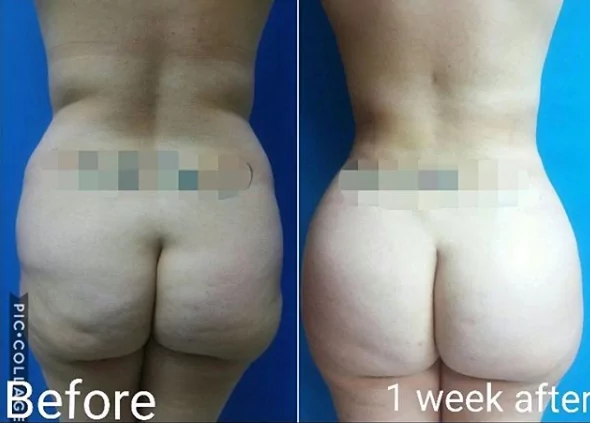 liposuction with fat transfer miami