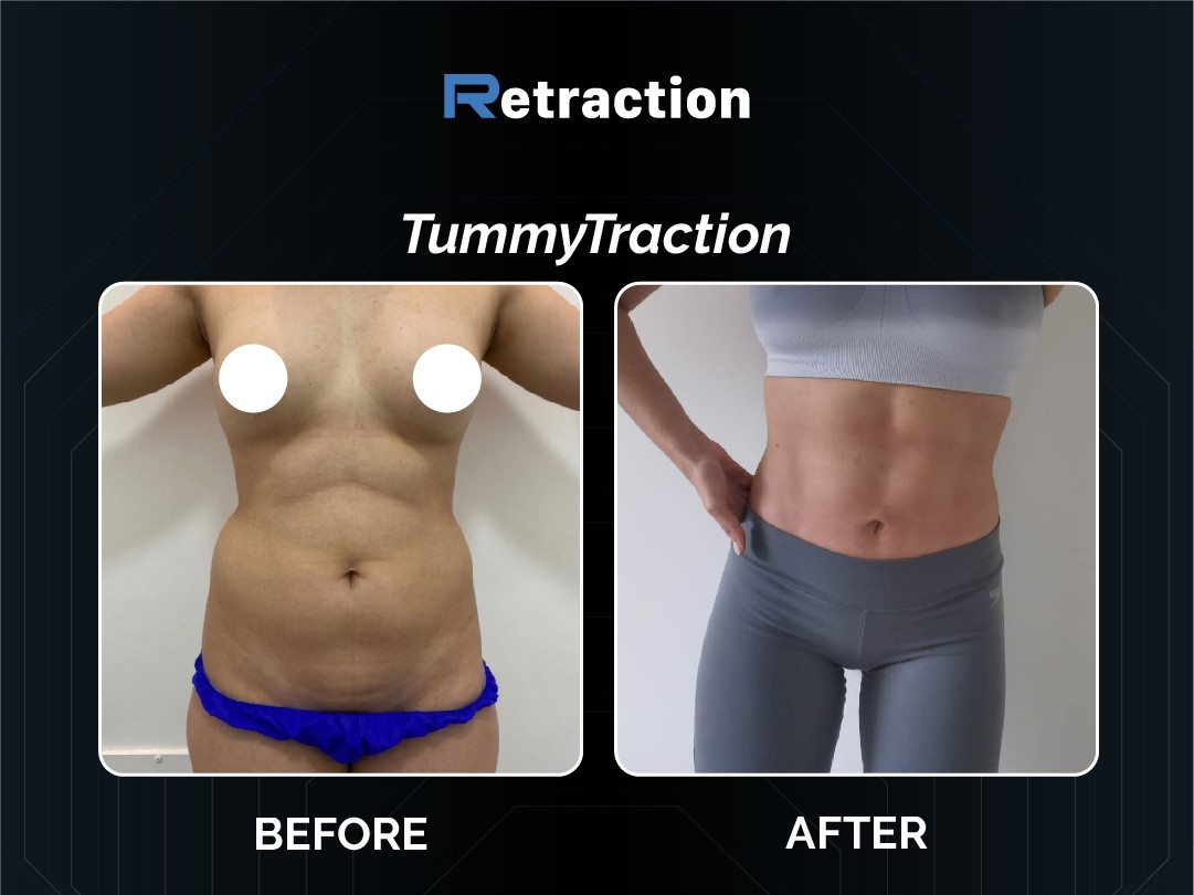 Retraction Tummy Tuck